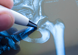 radiografia di frattura dell'anca